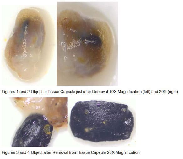 alienimplantate-nach-ufo-entfuehrung-robert-leir