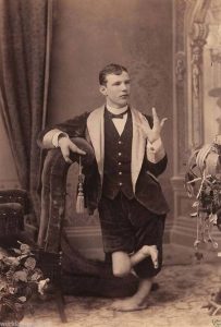 A-performer-with-severe-hand-and-feet-deformities.-600x888