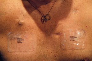Aug. 22, 2015 - Augusta, GA, USA - If I don t put these on, it hurts to breathe, says Smitty Anderson wearing Fentanyl patches to help him deal with the pain caused by multiple myeloma cancer, a blood cancer that affects the bones. Anderson worked at Savannah River Site from 1981 to 1998. The Andersons filed claims to get federal compensation for his disease, which he said came from working at the nuclear site. He had no luck. We ve been going through so much red tape for years, he said. My wife has to do all the work now. I just don t have the strength anymore. He died on Nov. 5, 2015. Augusta USA PUBLICATIONxINxGERxSUIxAUTxONLY - ZUMAm67_ Aug 22 2015 Augusta Ga USA If I Don T Put Thesis ON IT Hurts to Breathe Says Smitty Anderson said Wearing Patches to Help HIM Deal With The Pain CAUSED by Multiple Myeloma Cancer a Blood Cancer Thatcher affects The Bones Anderson said Worked AT Savannah River Site from 1981 to 1998 The Anderson Filed Claims to Get Federal Compensation for His Disease Which he Said Came from Working AT The Nuclear Site he had No Luck We ve been Going Through as Much Red Tape for Years he Said My wife has to Do All The Work Now I Just Don T have The Strength Anymore he died ON Nov 5 2015 Augusta USA PUBLICATIONxINxGERxSUIxAUTxONLY ZUMAm67_